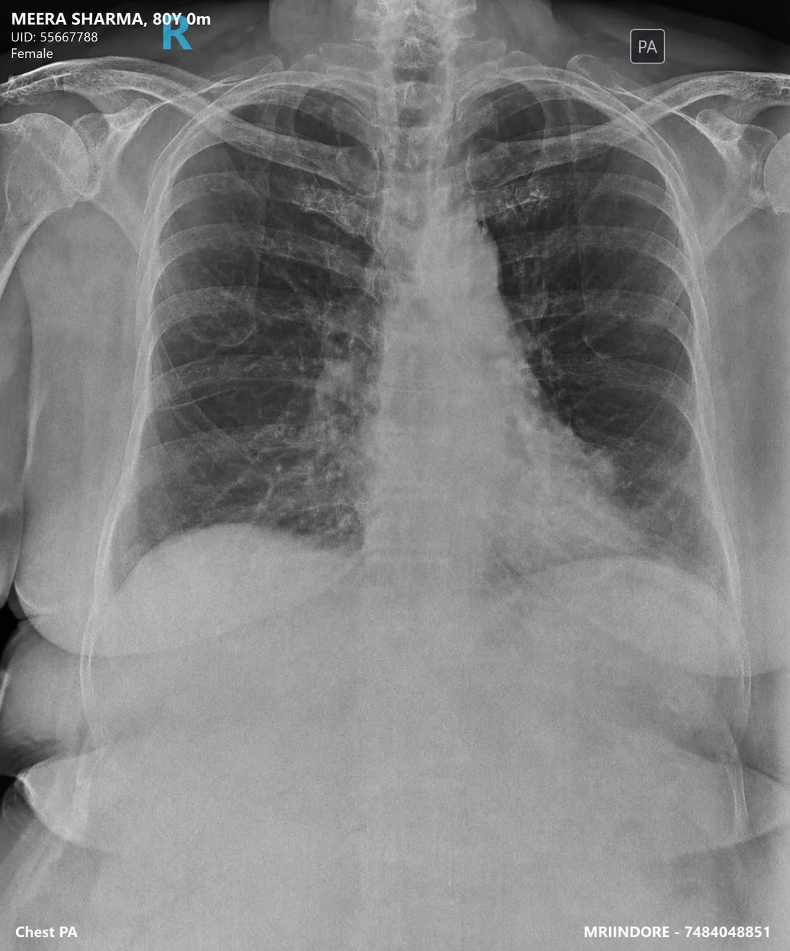 Sample PA chest X-ray digital radiograph